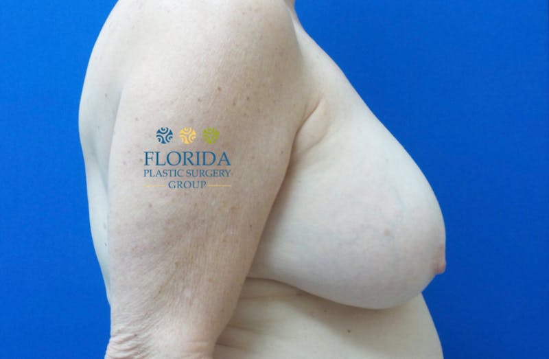 Breast Reduction Before & After Gallery - Patient 154949137 - Image 3