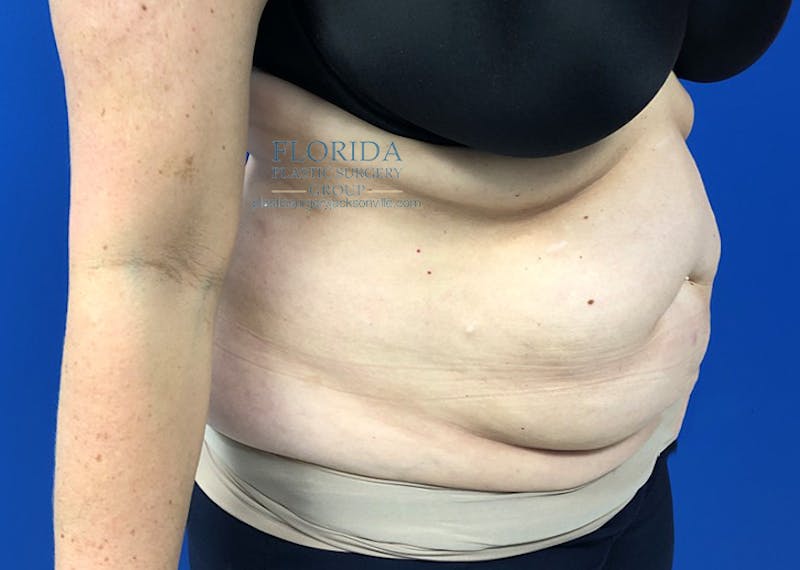 Abdominoplasty Before & After Gallery - Patient 154949142 - Image 3
