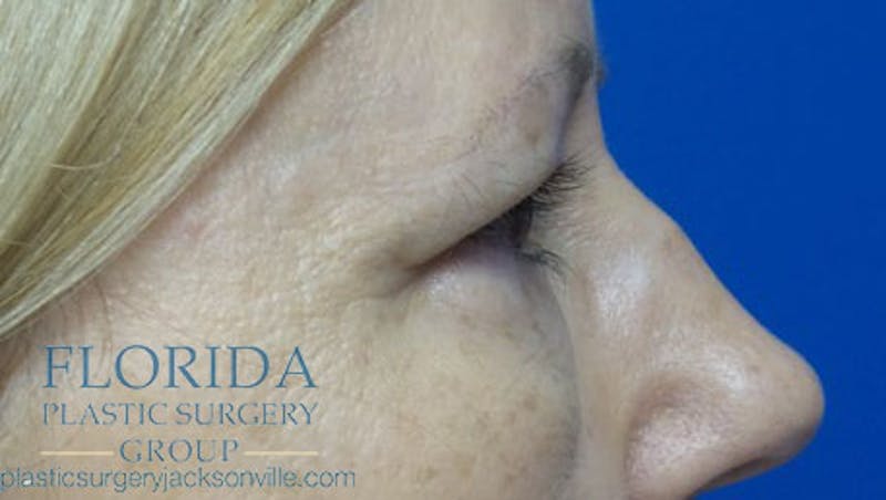 Blepharoplasty Before & After Gallery - Patient 154949139 - Image 3