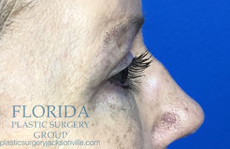 Blepharoplasty Before & After Gallery - Patient 154949139 - Image 4