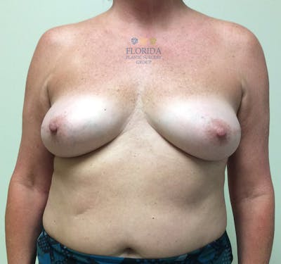 DIEP Flap Reconstruction Before & After Gallery - Patient 154951970 - Image 1