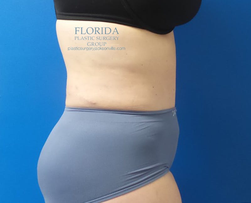 Abdominoplasty Before & After Gallery - Patient 154949142 - Image 4