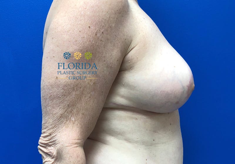 Breast Reduction Before & After Gallery - Patient 154949137 - Image 4