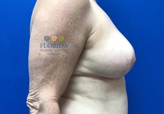 Breast Reduction Before & After Gallery - Patient 154949137 - Image 4