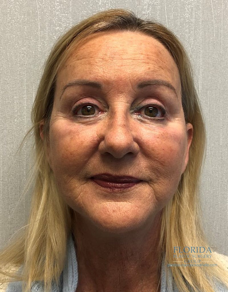 Facial Rejuvenation Before & After Gallery - Patient 154951979 - Image 2