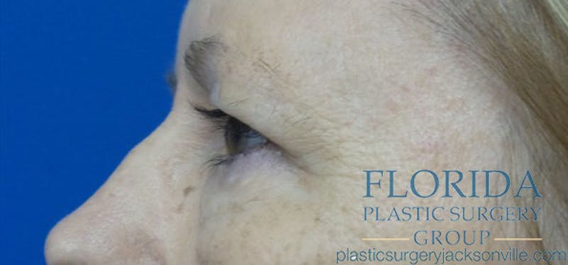 Blepharoplasty Before & After Gallery - Patient 154949139 - Image 5