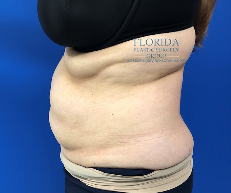 Abdominoplasty Before & After Gallery - Patient 154949142 - Image 5