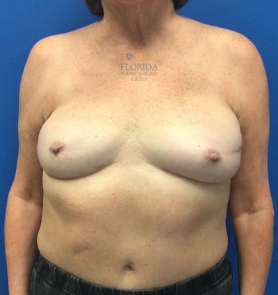 DIEP Flap Reconstruction Before & After Gallery - Patient 154951970 - Image 2