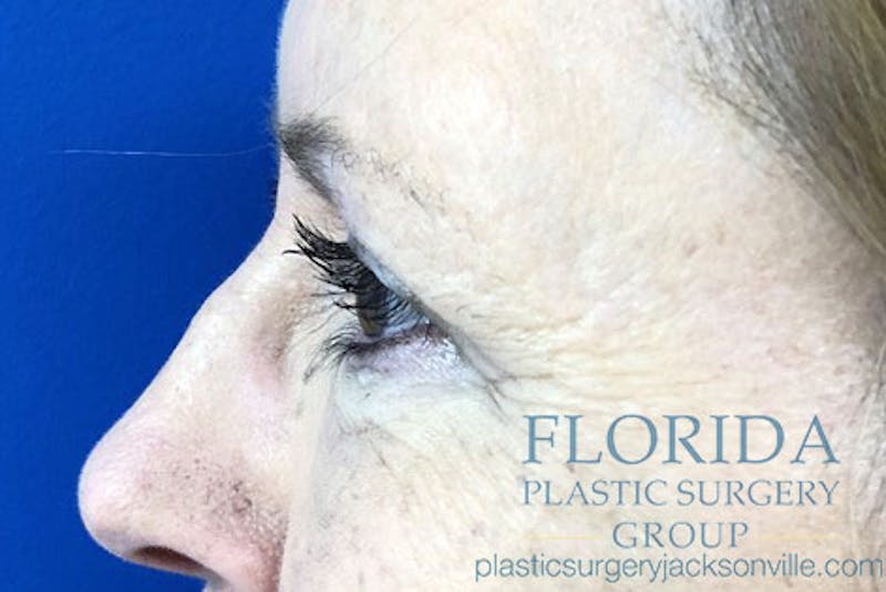 Blepharoplasty Before & After Gallery - Patient 154949139 - Image 6