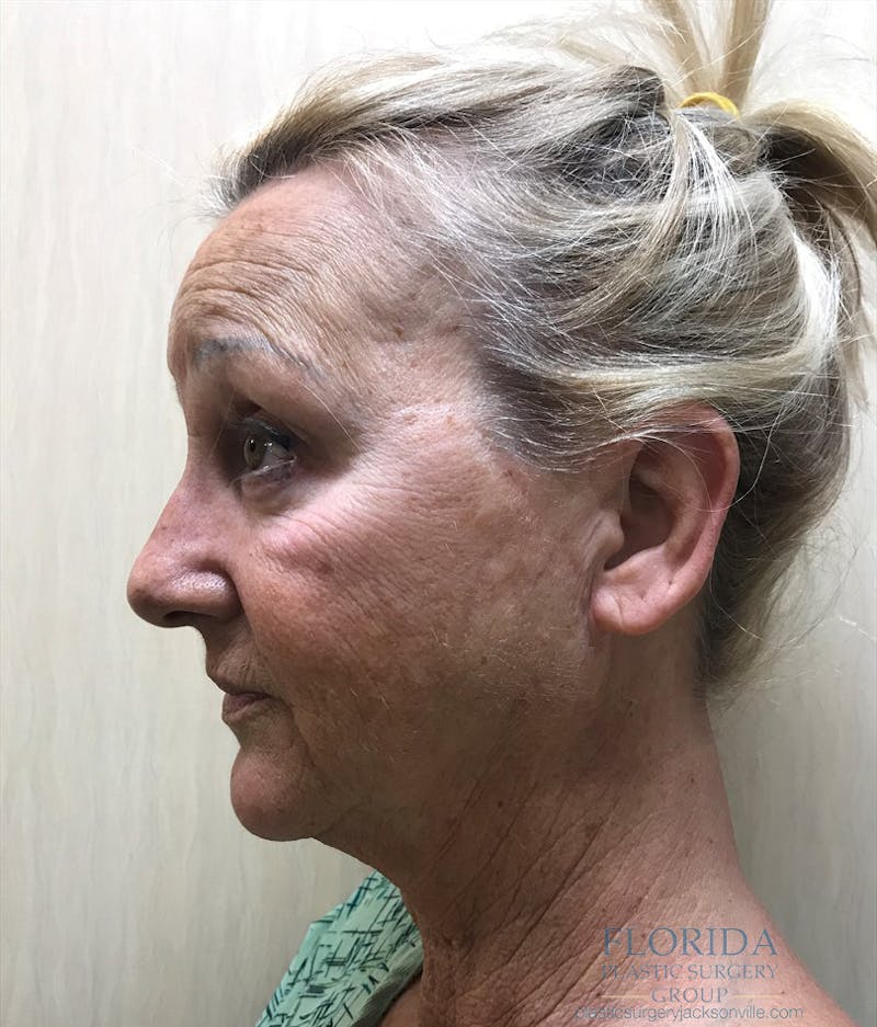 Facial Rejuvenation Before & After Gallery - Patient 154951979 - Image 3
