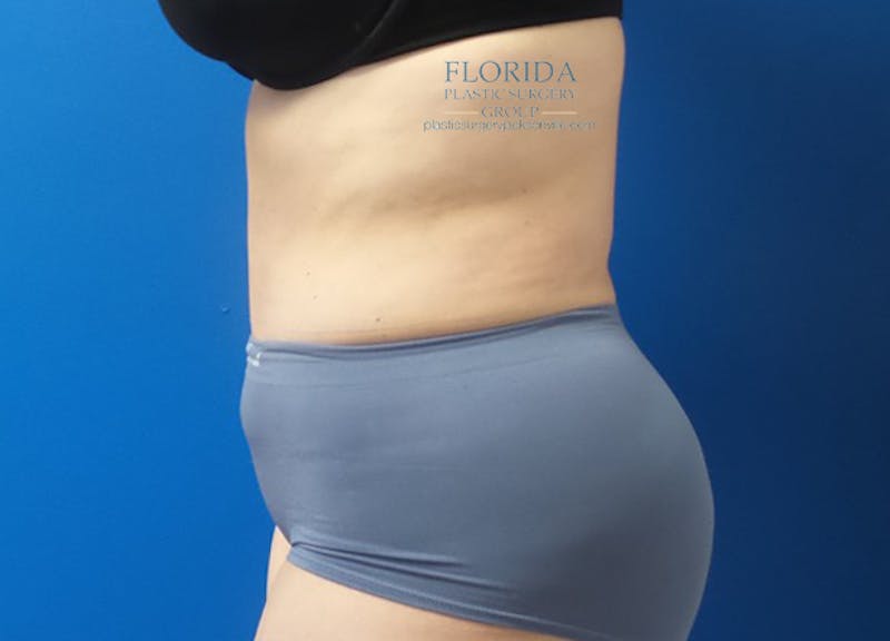 Abdominoplasty Before & After Gallery - Patient 154949142 - Image 6