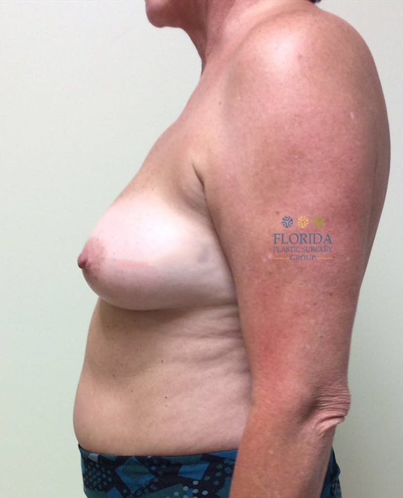 DIEP Flap Reconstruction Before & After Gallery - Patient 154951970 - Image 3