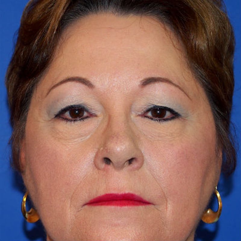 Blepharoplasty Before & After Gallery - Patient 154951972 - Image 1