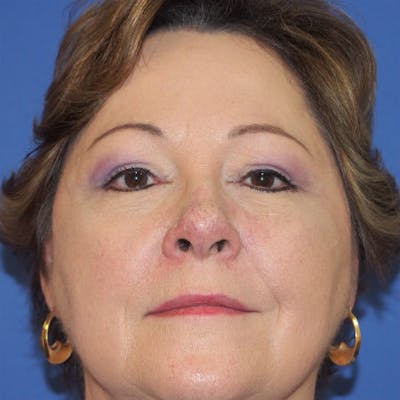 Blepharoplasty Before & After Gallery - Patient 154951972 - Image 2