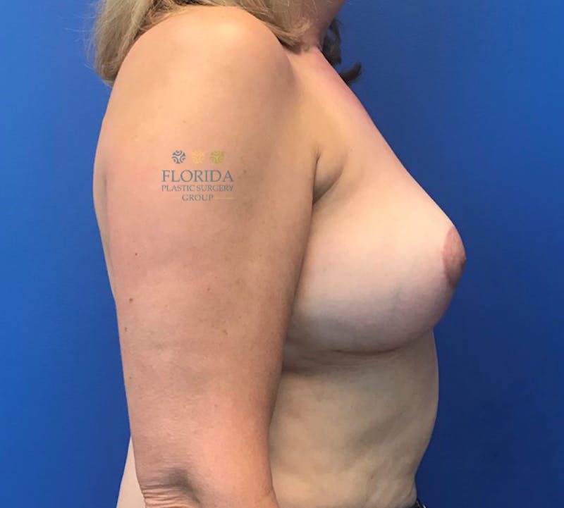 Breast Implant Removal Before & After Gallery - Patient 154951976 - Image 4