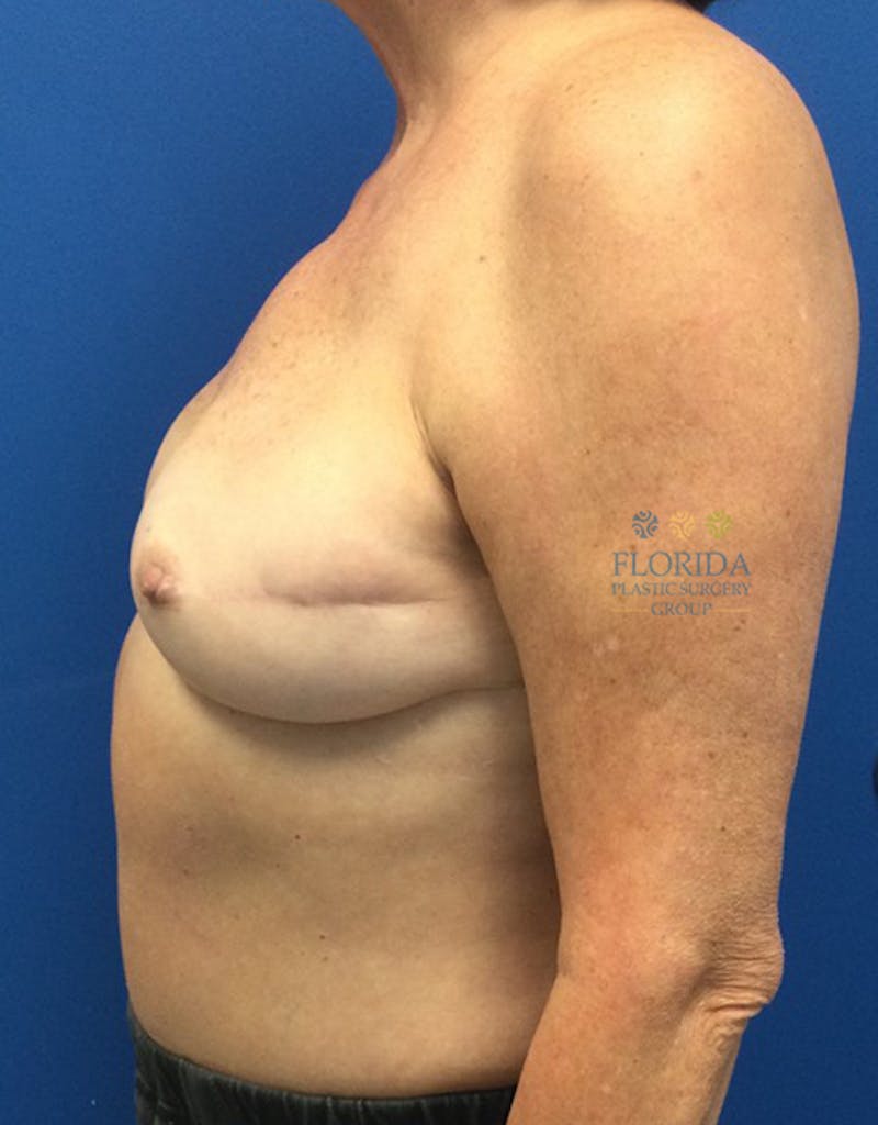 DIEP Flap Reconstruction Before & After Gallery - Patient 154951970 - Image 4