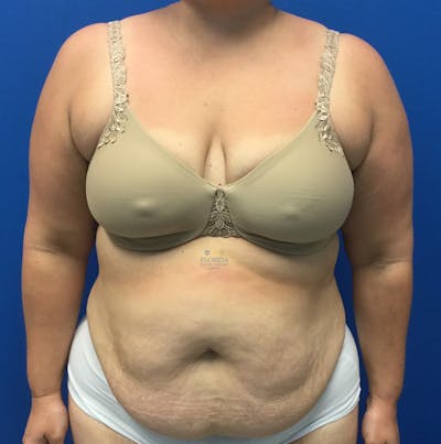 Abdominoplasty Before & After Gallery - Patient 154951992 - Image 1