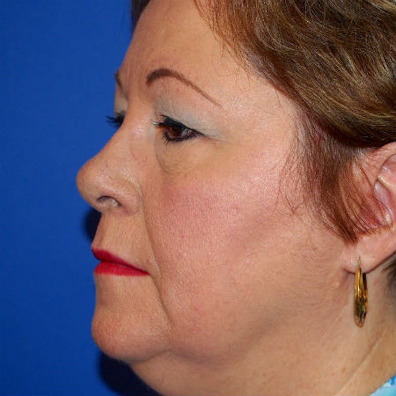 Blepharoplasty Before & After Gallery - Patient 154951972 - Image 3