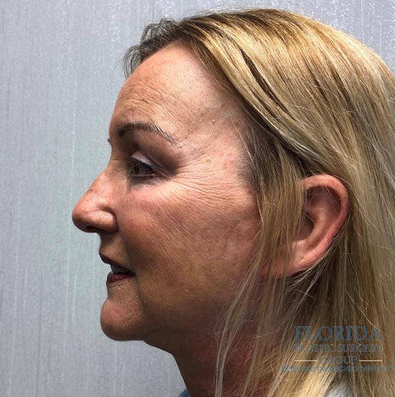 Facial Rejuvenation Before & After Gallery - Patient 154951979 - Image 4