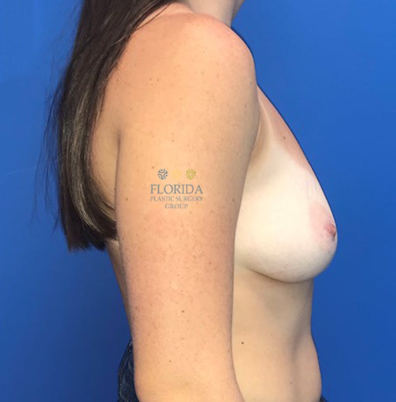 Silicone Breast Augmentation Before & After Gallery - Patient 154951975 - Image 5
