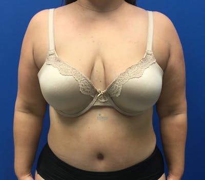 Abdominoplasty Before & After Gallery - Patient 154951992 - Image 2
