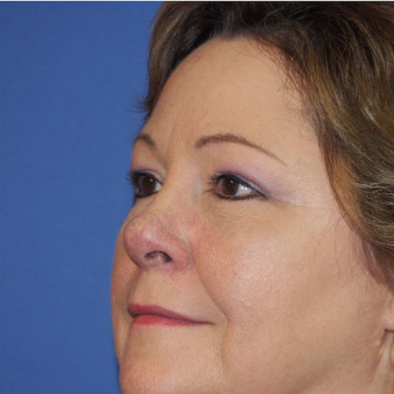 Blepharoplasty Before & After Gallery - Patient 154951972 - Image 4