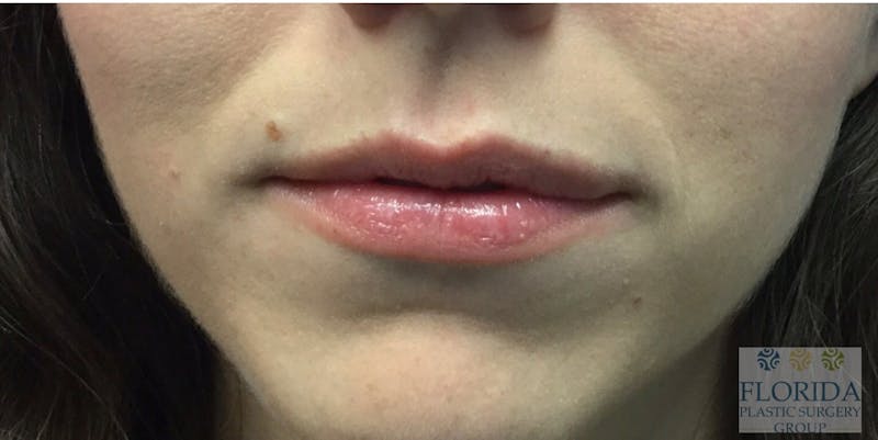 Injectables and Dermal Fillers Before & After Gallery - Patient 154951980 - Image 1