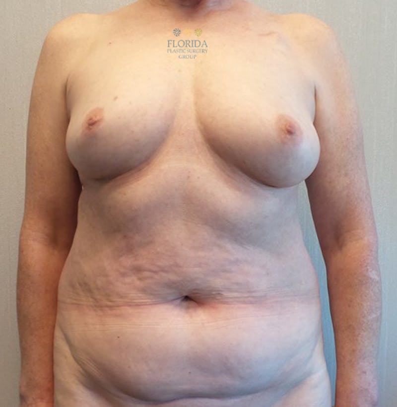 DIEP Flap Reconstruction Before & After Gallery - Patient 154951986 - Image 1