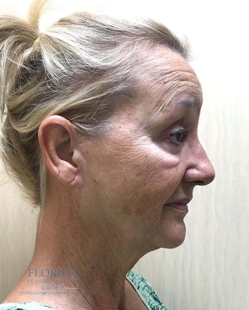 Facial Rejuvenation Before & After Gallery - Patient 154951979 - Image 5