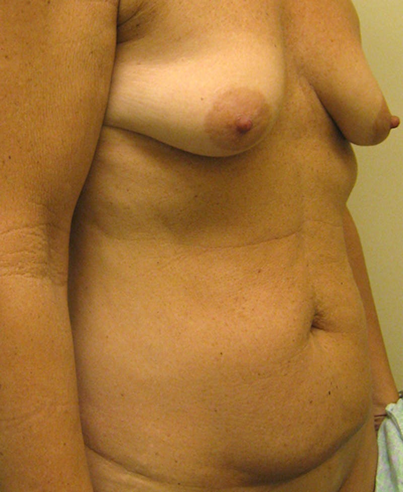 Mommy Makeover Before & After Gallery - Patient 154951987 - Image 3