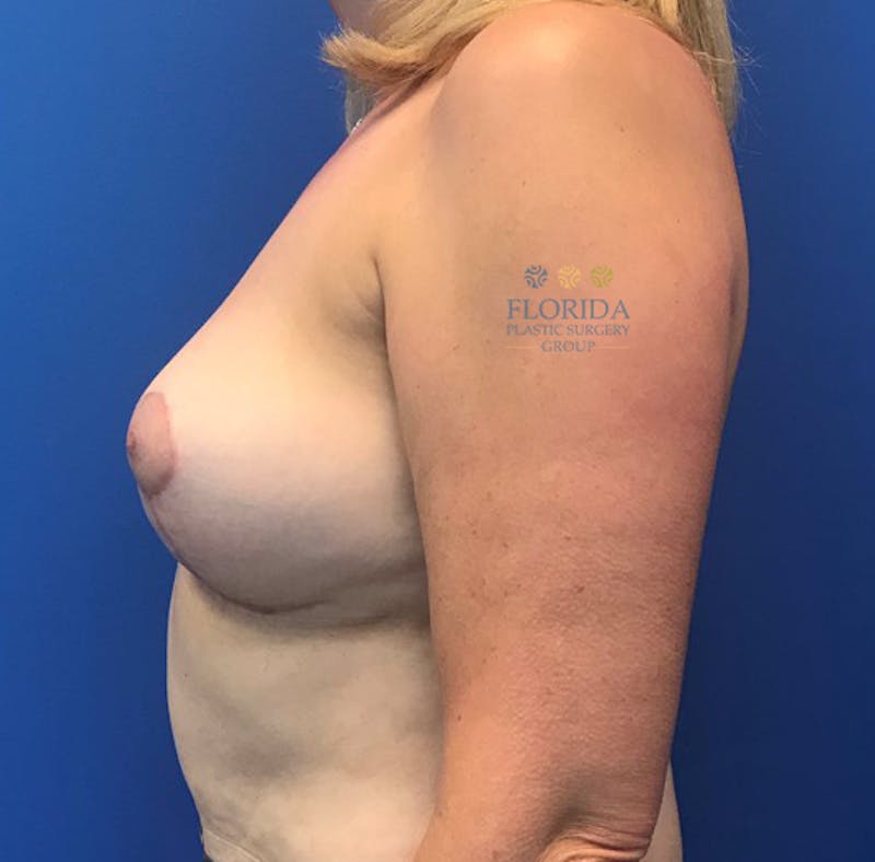 Breast Implant Removal Before & After Gallery - Patient 154951976 - Image 6