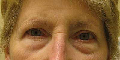 Blepharoplasty Before & After Gallery - Patient 154951984 - Image 1
