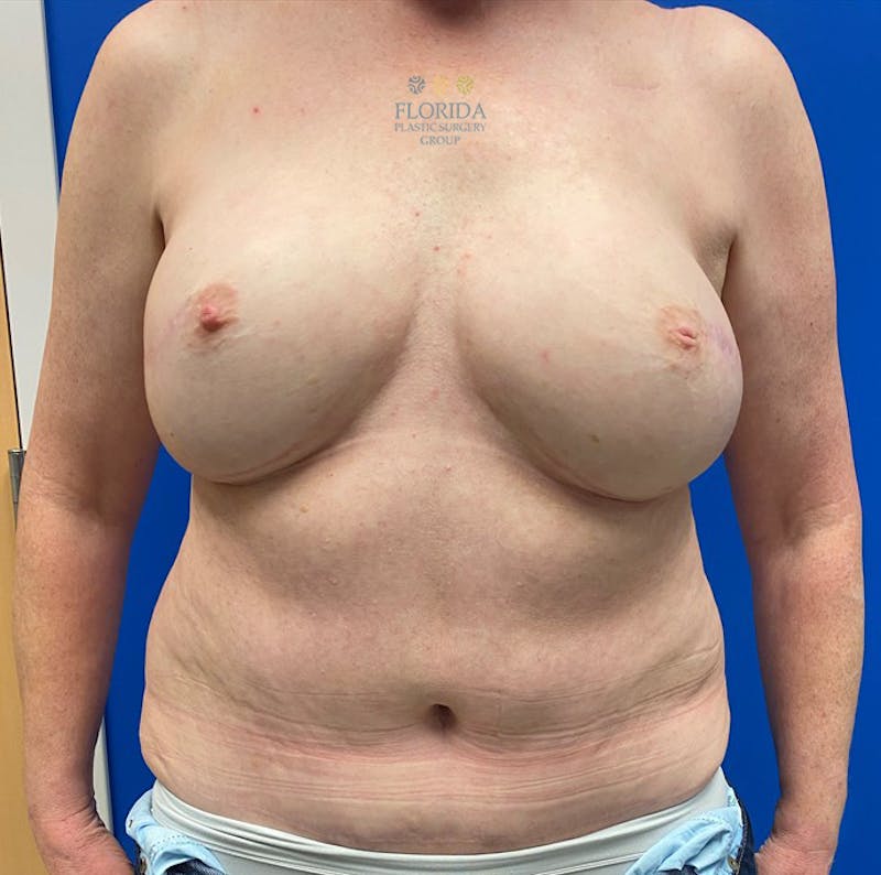 DIEP Flap Reconstruction Before & After Gallery - Patient 154951986 - Image 2