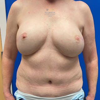 DIEP Flap Reconstruction Before & After Gallery - Patient 154951986 - Image 2