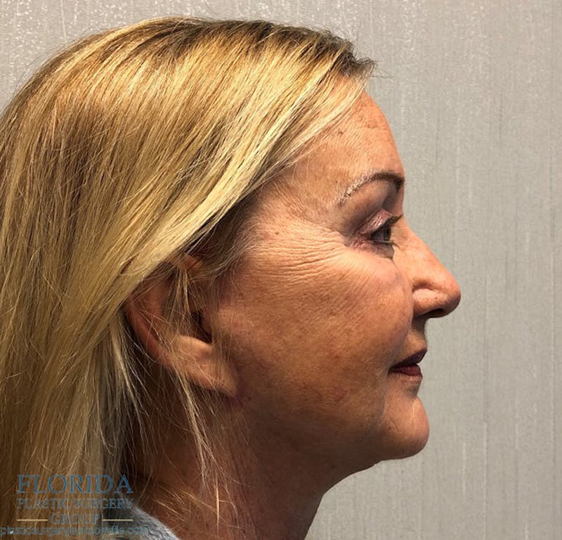 Facial Rejuvenation Before & After Gallery - Patient 154951979 - Image 6
