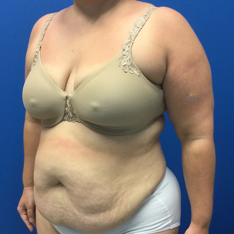 Abdominoplasty Before & After Gallery - Patient 154951992 - Image 3
