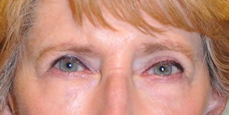 Blepharoplasty Before & After Gallery - Patient 154951984 - Image 2