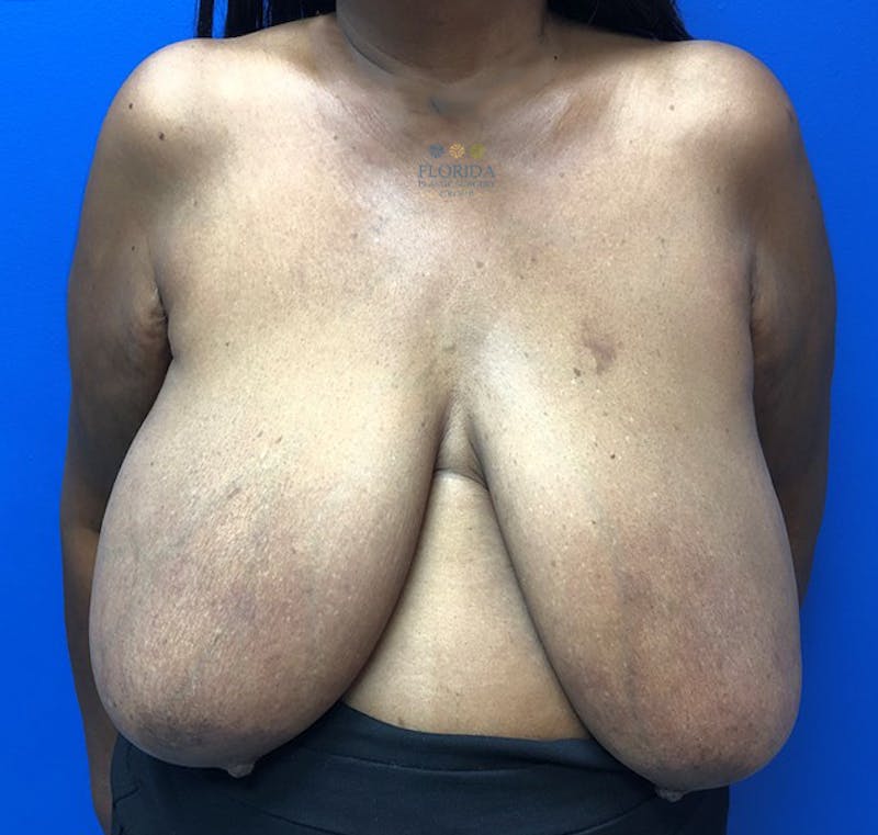 Breast Reduction Before & After Gallery - Patient 154951985 - Image 1