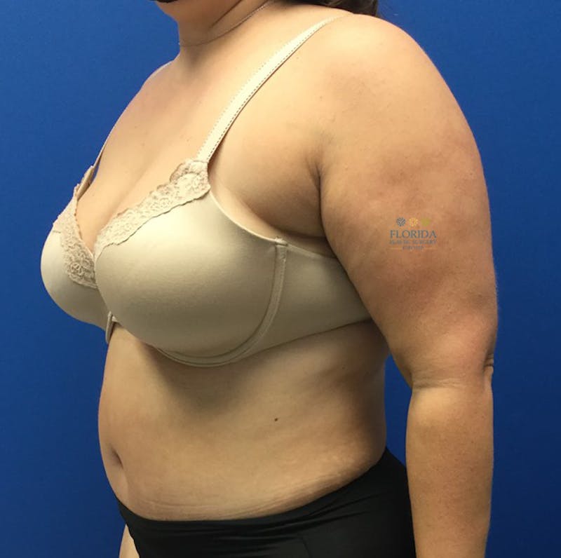 Abdominoplasty Before & After Gallery - Patient 154951992 - Image 4