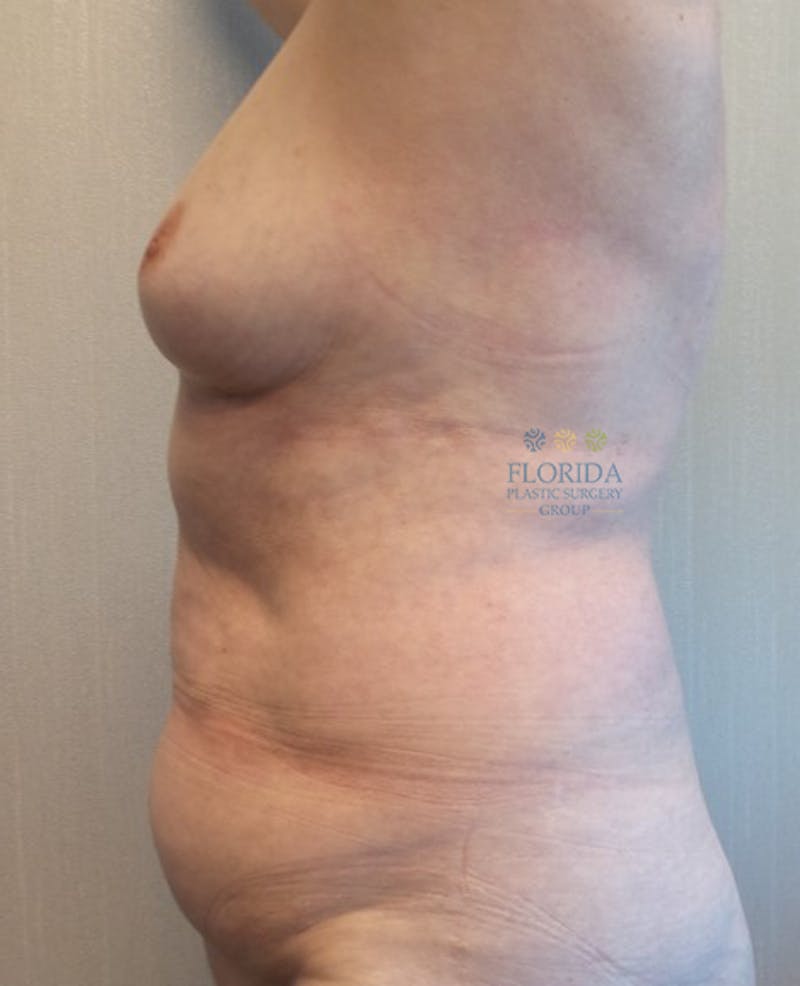 DIEP Flap Reconstruction Before & After Gallery - Patient 154951986 - Image 3