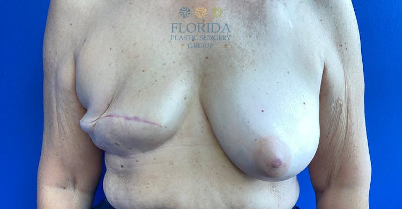 Tissue Expander Reconstruction Before & After Gallery - Patient 154952001 - Image 1