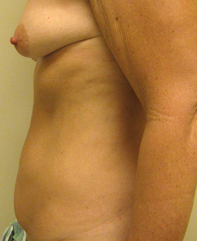 Mommy Makeover Before & After Gallery - Patient 154951987 - Image 5