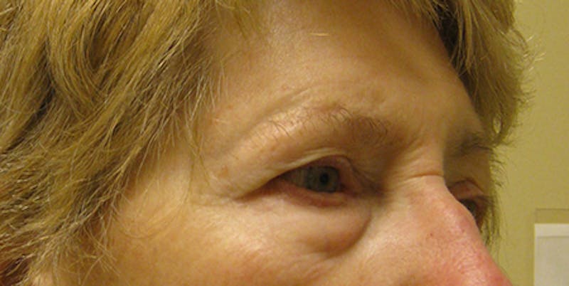 Blepharoplasty Before & After Gallery - Patient 154951984 - Image 3