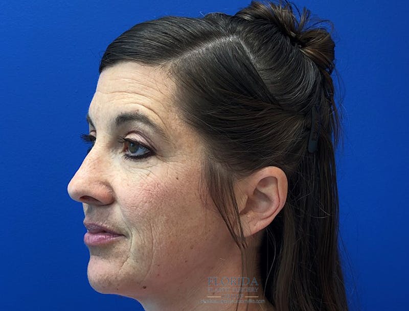 Facial Rejuvenation Before & After Gallery - Patient 154951998 - Image 1