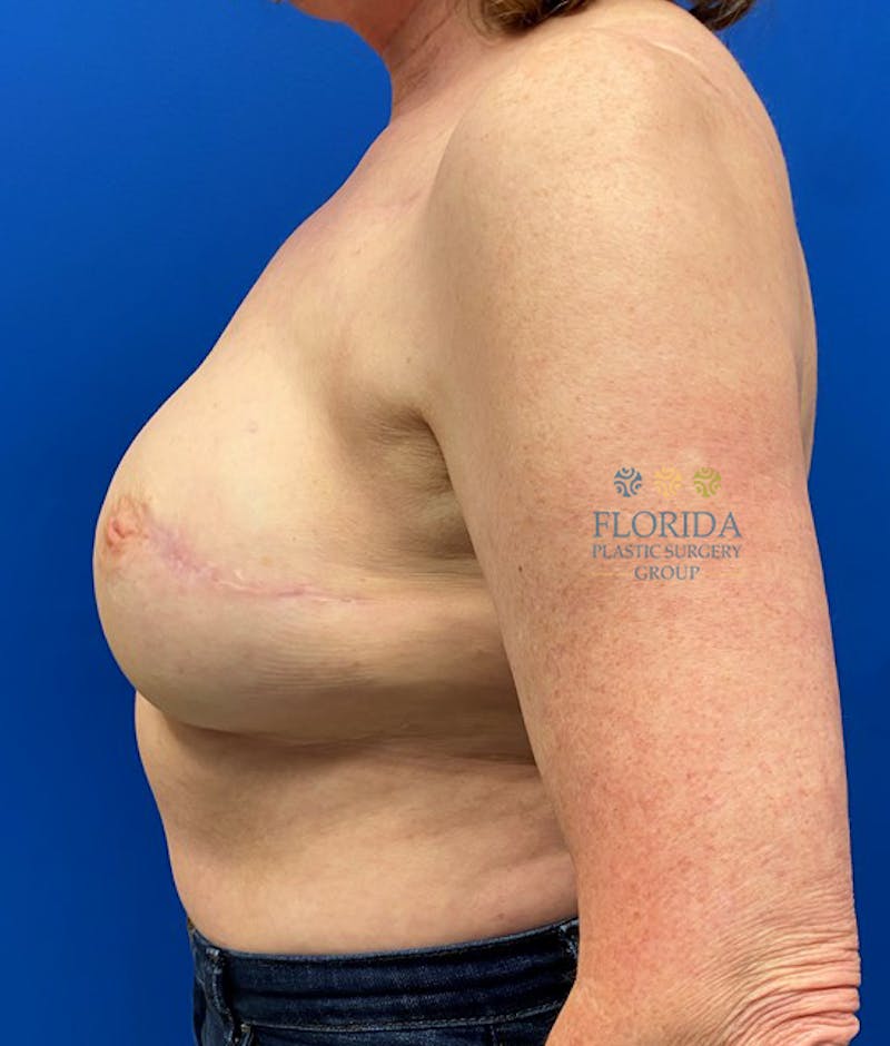 DIEP Flap Reconstruction Before & After Gallery - Patient 154951986 - Image 4