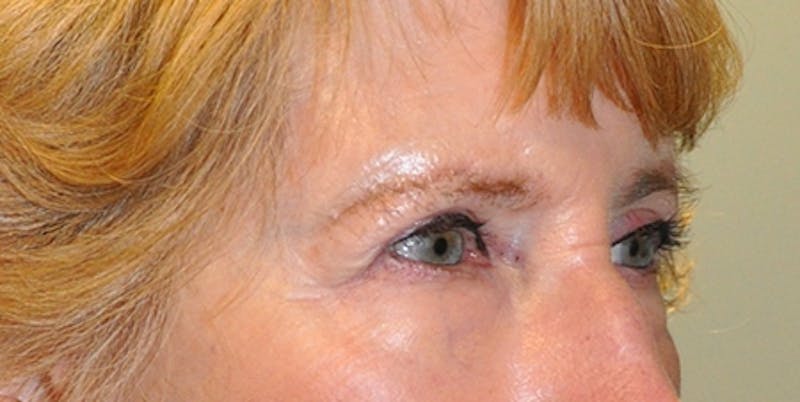 Blepharoplasty Before & After Gallery - Patient 154951984 - Image 4