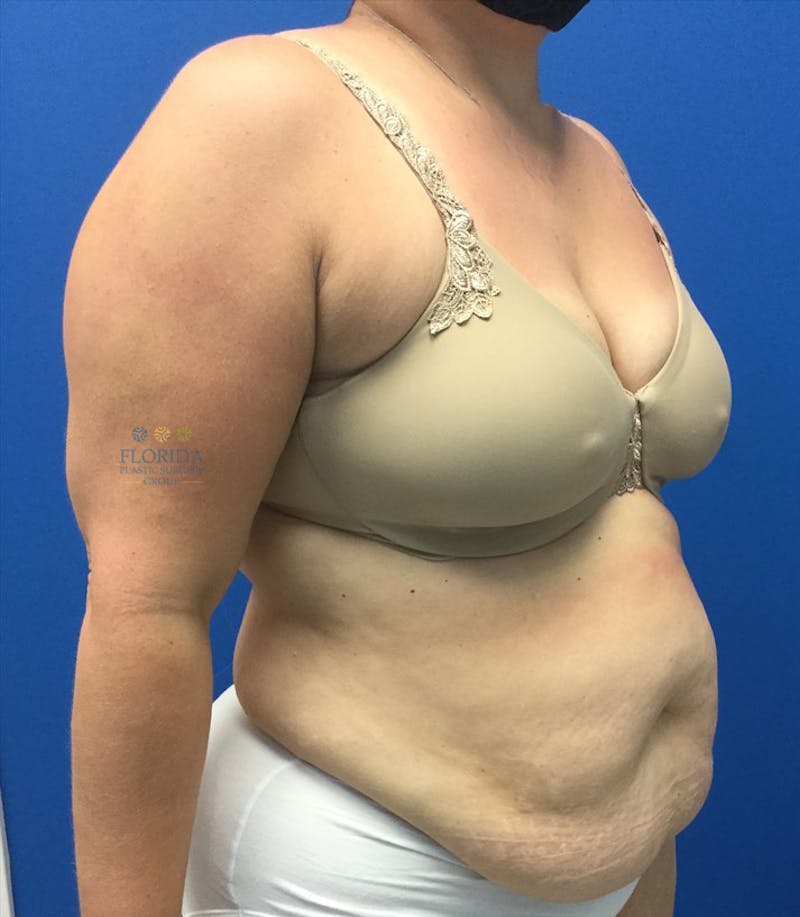 Abdominoplasty Before & After Gallery - Patient 154951992 - Image 5