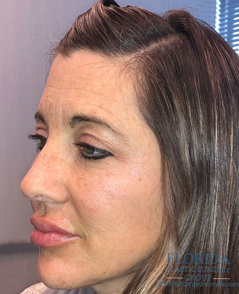 Facial Rejuvenation Before & After Gallery - Patient 154951998 - Image 2