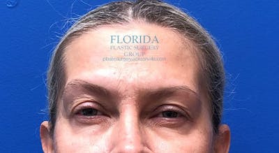 Blepharoplasty Before & After Gallery - Patient 154952000 - Image 1
