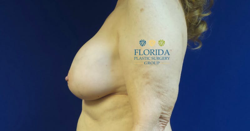 Breast Implant Removal Before & After Gallery - Patient 154951997 - Image 3